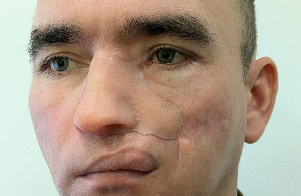 Відновлення обличчя після військових поранень: досвід ектопротезування