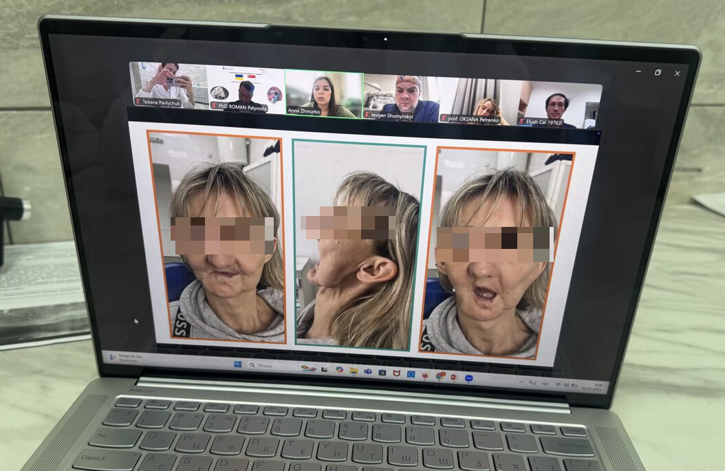Complex maxillofacial defects with free flap reconstruction