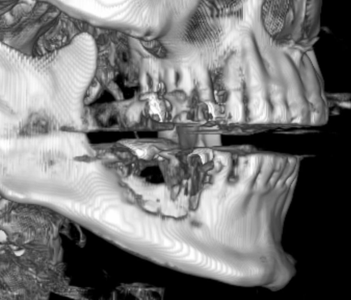 3D-комп'ютерна томографія нижньої щелепи з ознаками медикаментозно-обумовленого остеонекрозу, візуалізація ділянок кісткової деструкції